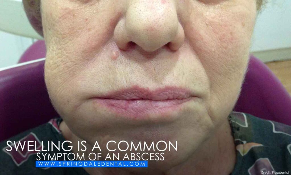 Swelling-is-a-common-symptom-of-an-abscess