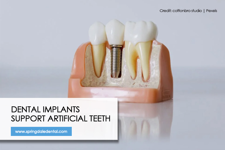 Dental implants support artificial teeth