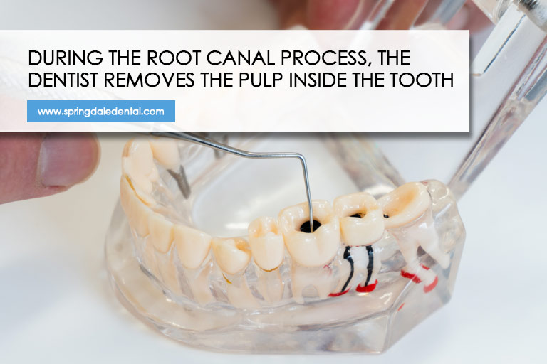 During the root canal process, the dentist removes the pulp inside the tooth