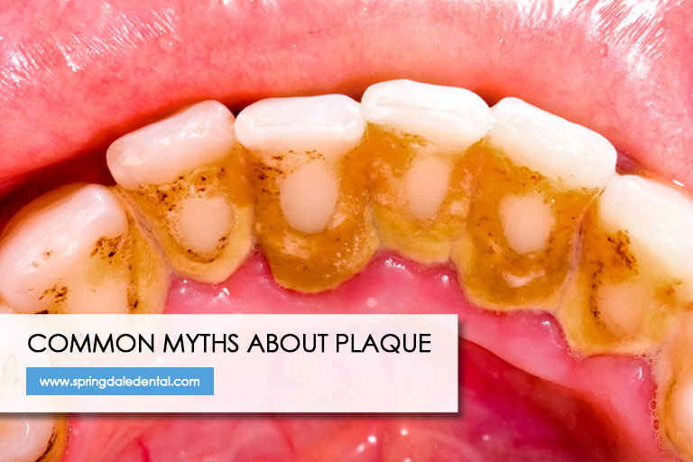 Common Myths About Plaque