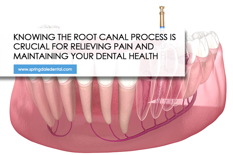 Knowing the root canal process is crucial for relieving pain and maintaining your dental health