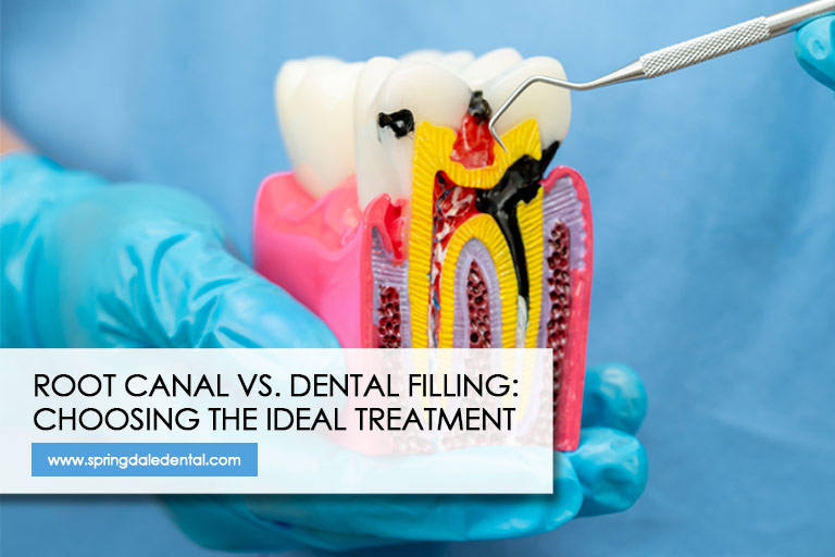 Root Canal vs. Dental Filling: Choosing the Ideal Treatment