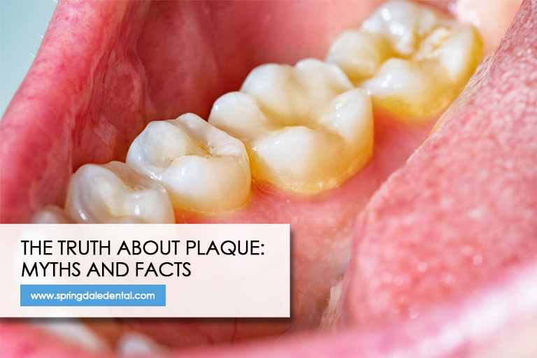 The Truth About Plaque: Myths and Facts