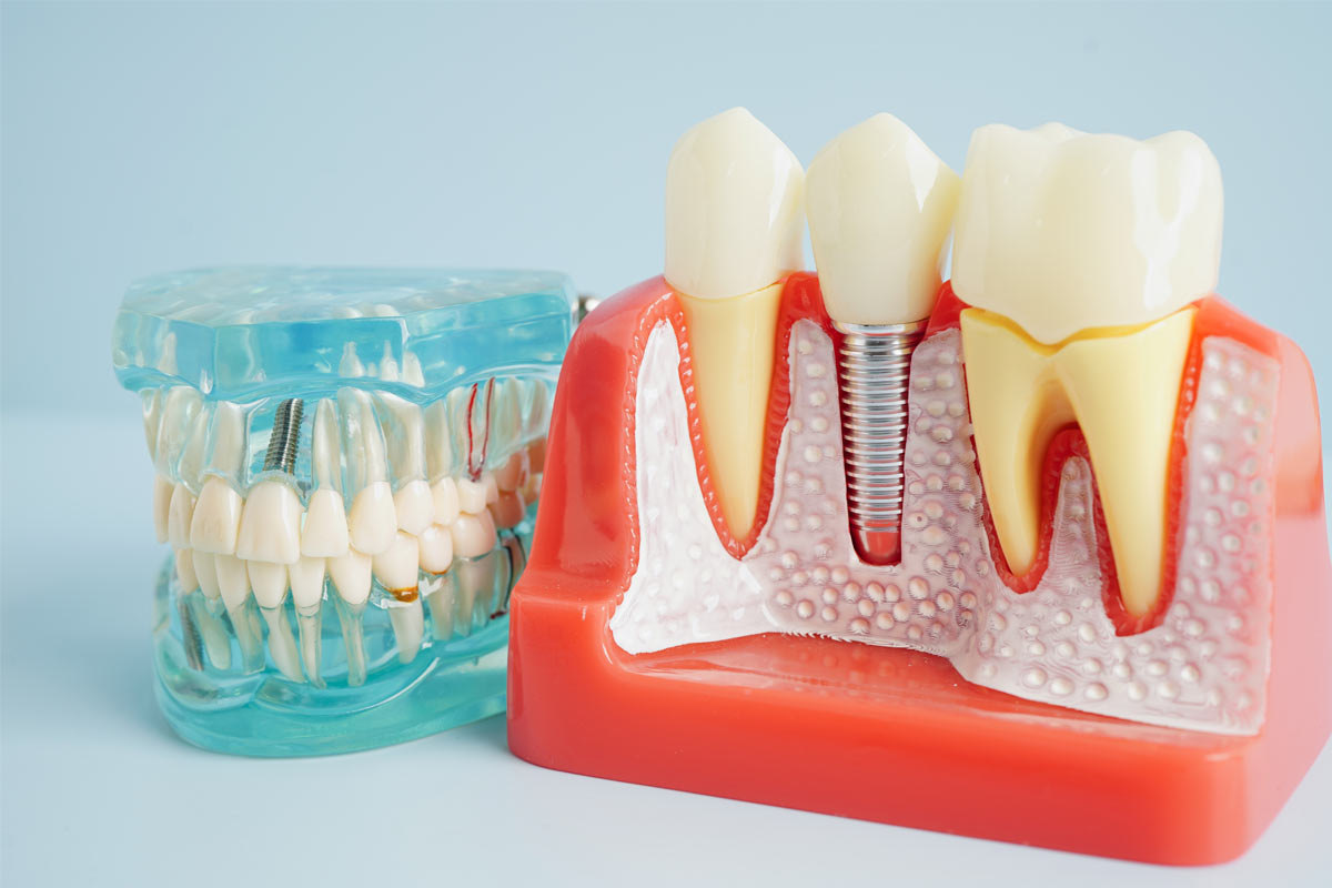 9 Lifestyle Changes That Help Dental Implants Last Longer