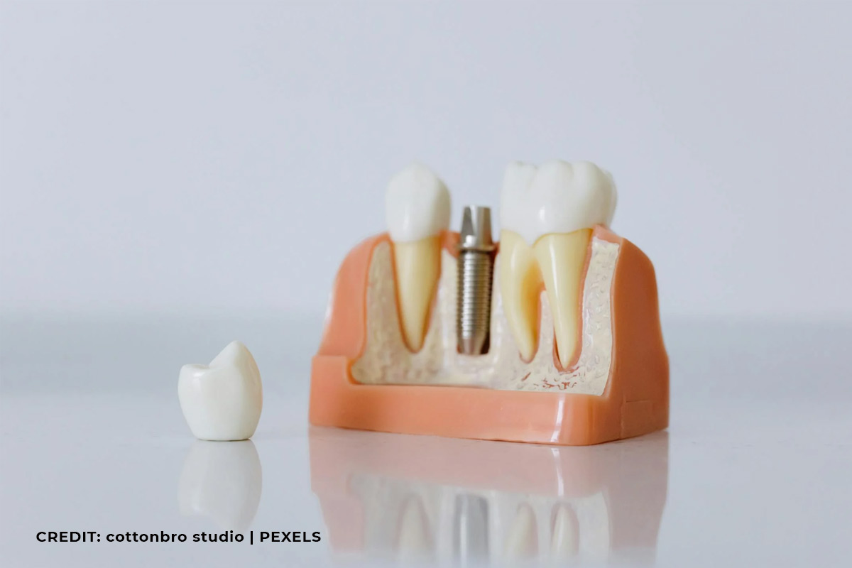 Dental Implants vs. Bridges: Which Tooth Replacement Option Should You Go For?