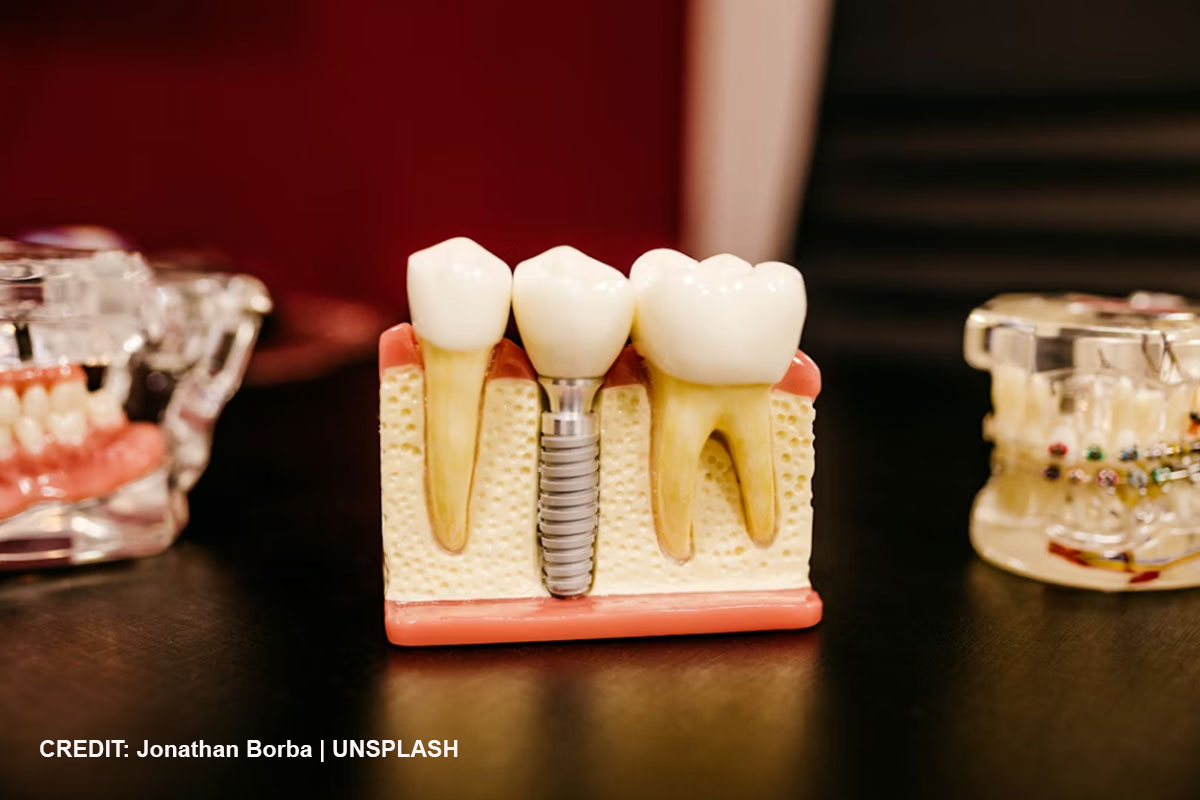 Dental Implants 101: Everything You Need to Know about Getting Them Yourself