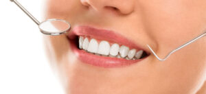 Teeth Whitening
