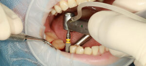 Dental Implants