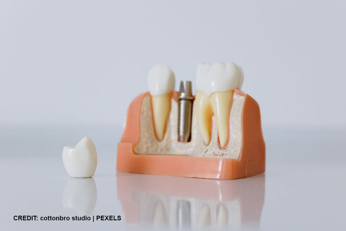 Bridges, Dentures, or Implants? Finding the Right Fit for Your Smile
