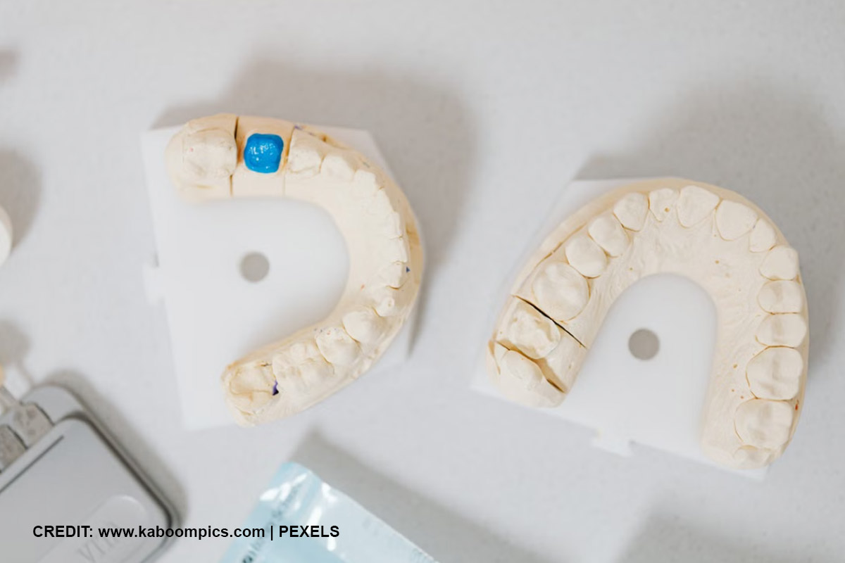 The Gold Standard: Dental Implants