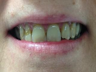 bonding of front teeth springdale
